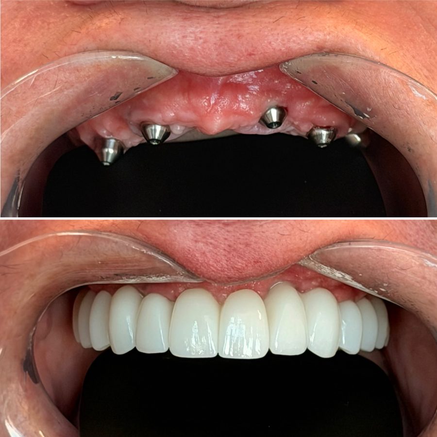 Upper arch All-on-X implants before and after at Neo Implant Dental Group