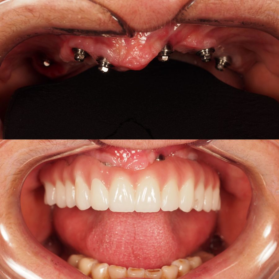 All-on-4 dental implants before and after at Neo Implant Dental Group in San Bernardino