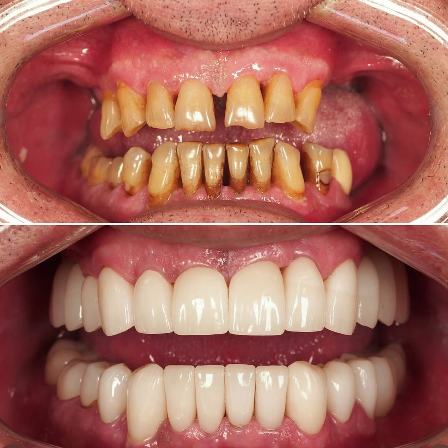 Full mouth dental implants before and after at Neo Implant Dental Group in San Bernardino