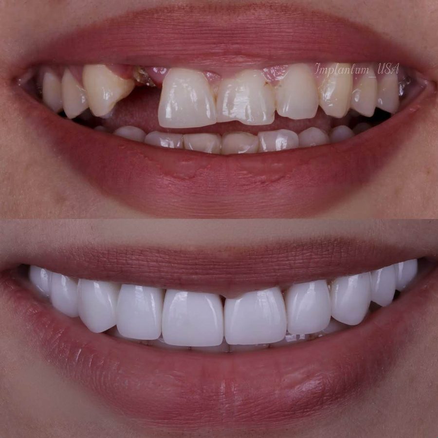 Smile makeover before and after at Neo Implant Dental Group in San Bernardino