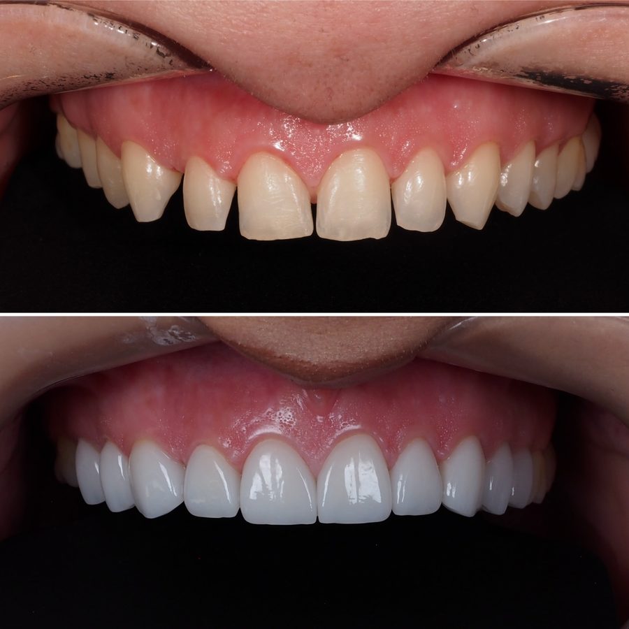 Porcelain veneers before and after at Neo Implant Dental Group in San Bernardino